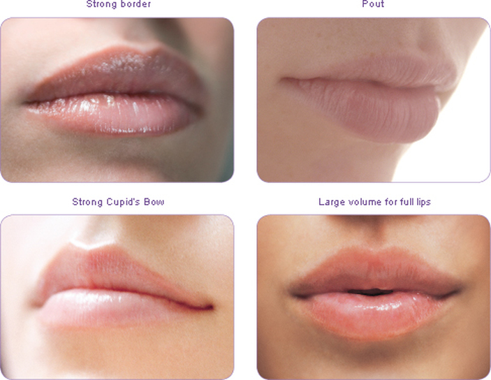 LIP Augmentation – Skin Specialist Dubai